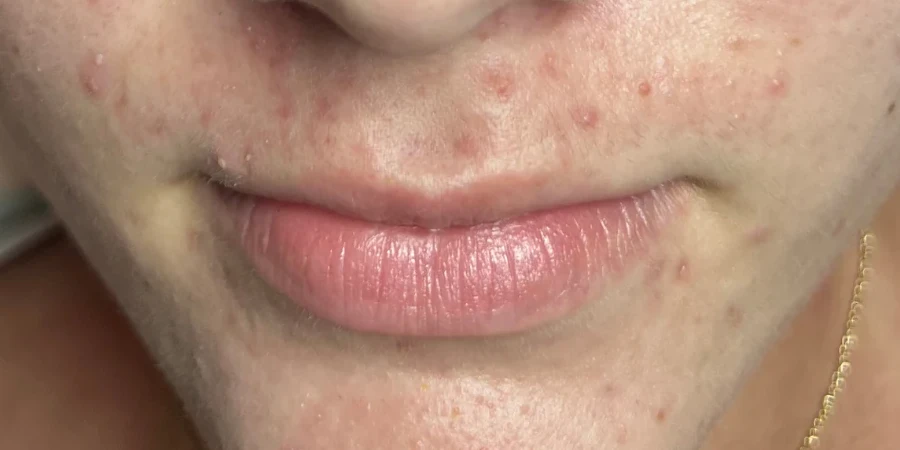 Acne Facial, after