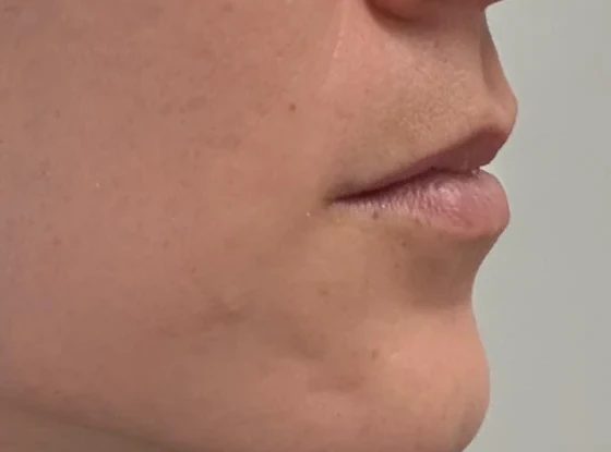 Lower Face Botox, after