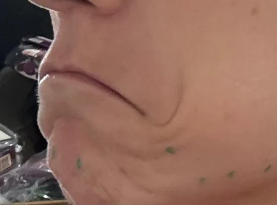 Lower Face Botox, before